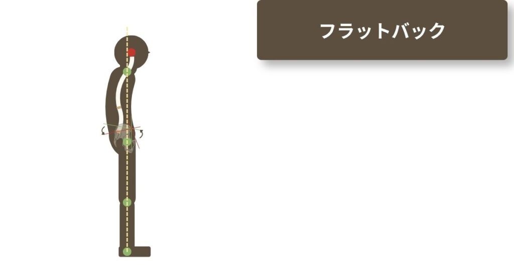 フラットバックの参考図。骨盤の後傾により、腰椎の前弯（反りが消えて）胸椎はそのまま残るため、猫背のような印象になる。