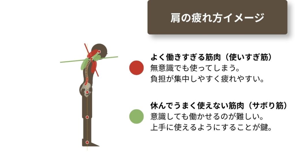上位交差症候群を簡単に示したイメージ図。