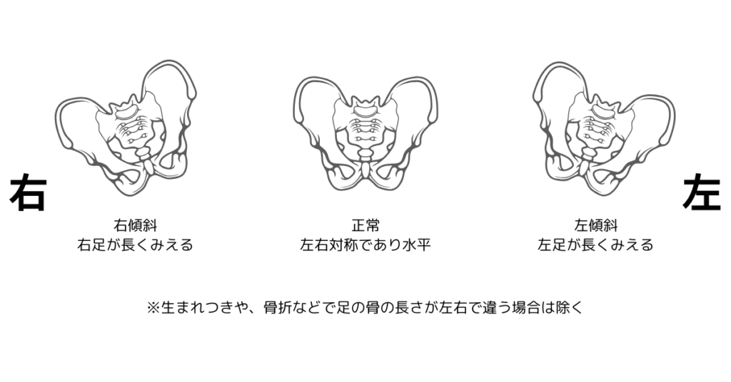 骨盤の左右の傾き・傾斜の画像