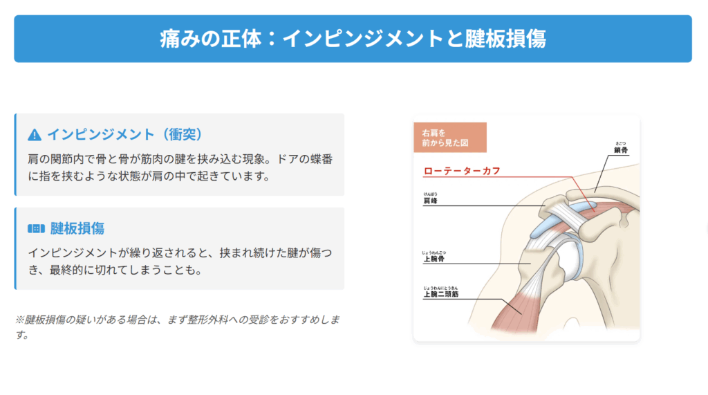痛みの正体：インピンジメントと腱板損傷
インピンジメント：肩の関節寧で骨と骨が筋肉の腱を挟み込む現象ドアの蝶番に指を挟むような状態が肩の中で起きています。
腱板損傷：インピンジメントが繰り返されると、挟まれ続けた腱が傷つき、最終的に切れてしまうことも。