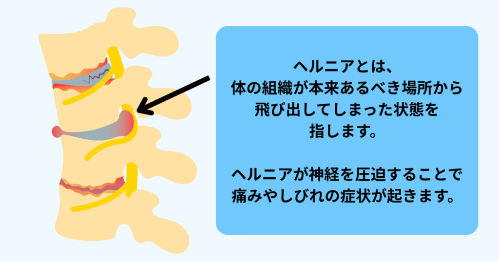 椎間板ヘルニアの説明イラスト
ヘルニアとは、
体の組織が本来あるべき場所から
飛び出してしまった状態を
指します。
ヘルニアが神経を圧迫することで
痛みやしびれの症状が起きます。