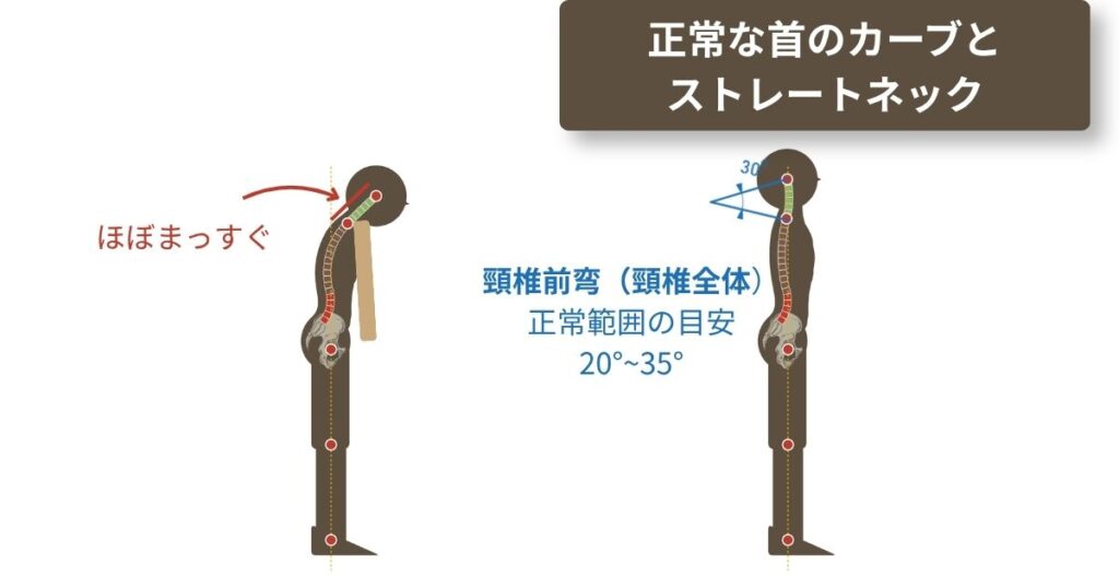 正常な首の前弯カーブと、カーブが減ったストレートネックの首を横から並べて比べた図