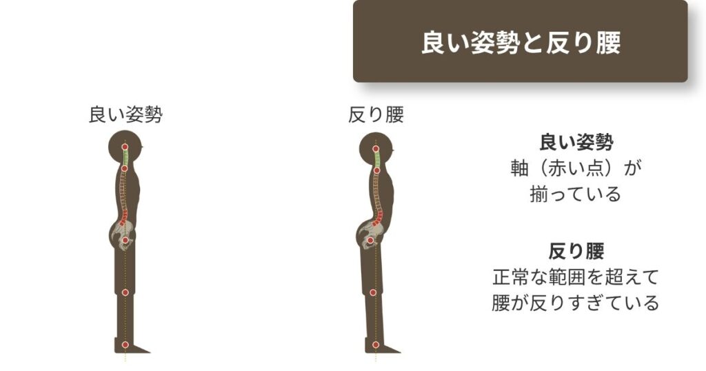 良い姿勢と反り腰の比較図。