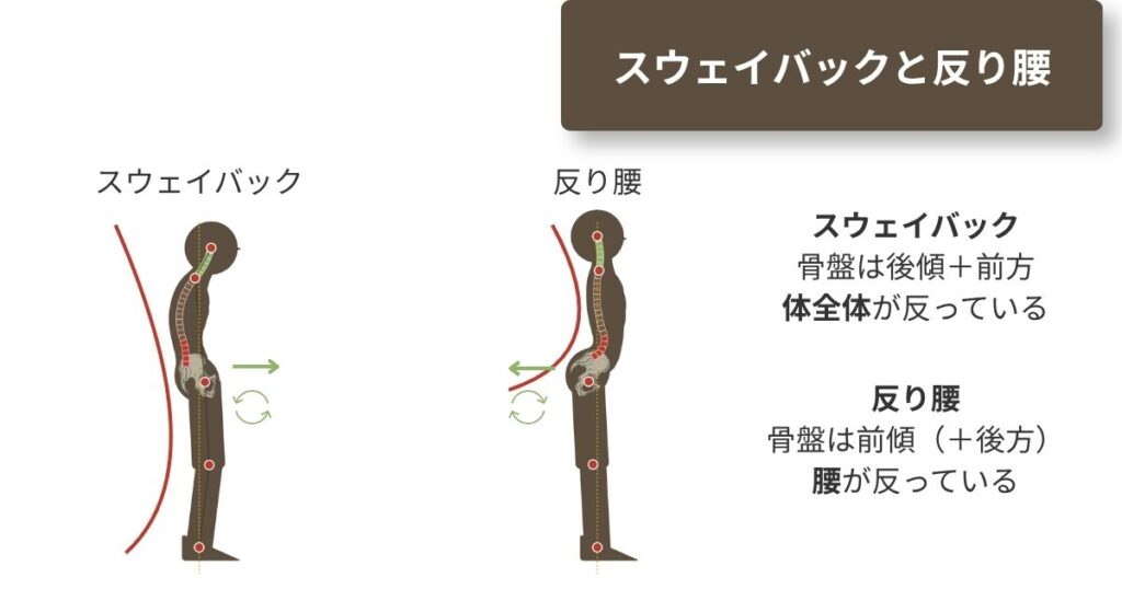 スウェイバック(骨盤前方スライド+後傾)と反り腰(骨盤前傾)の骨盤位置の違い。比較図。